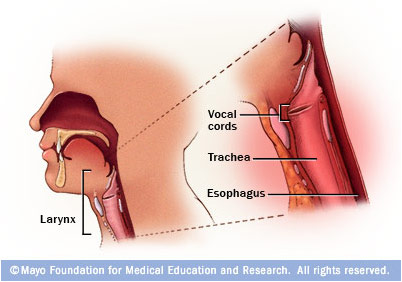 larynx cancer pictures