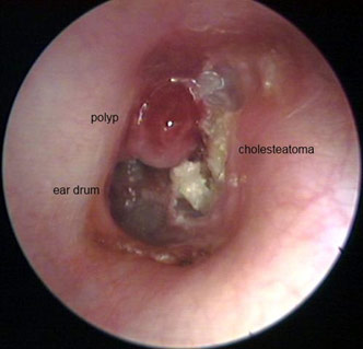 Cholesteatoma Ear Surgery (Tympanomastoidectomy) - ENT Clinic inside ear drum diagram 