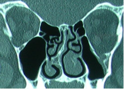 CT-sinus img69 Turbinate Reduction