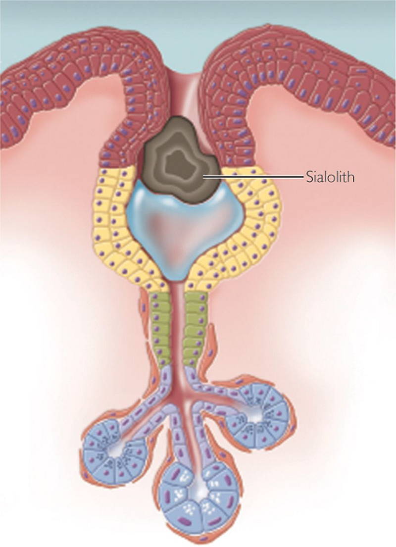 Sialolithiasis - ENT Clinic Sydney diagram of infected salivary glands 